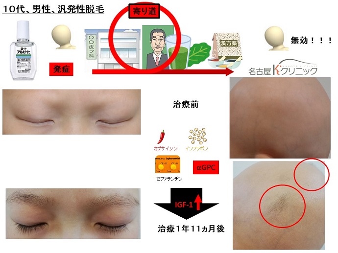 円形脱毛症　病院